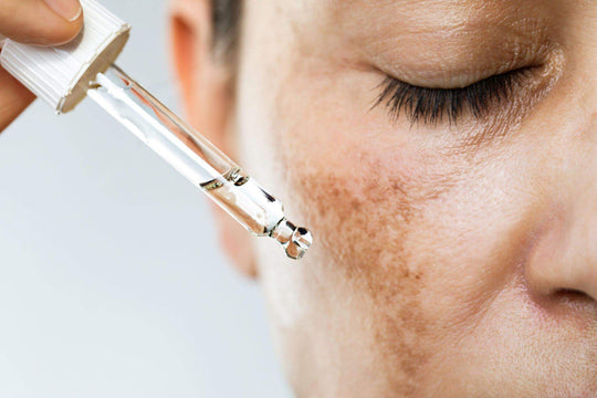 Understanding Melasma from a Holistic Approach