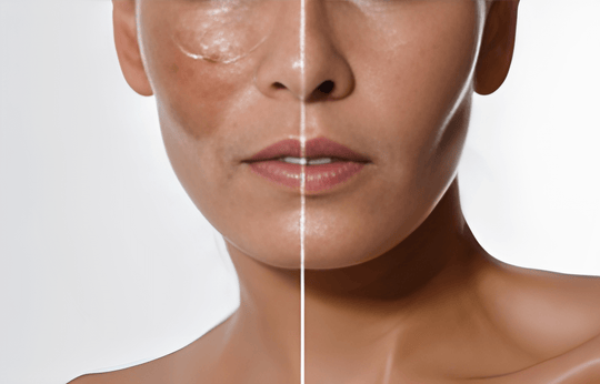 5 Tips to Get Rid of Hyperpigmentation and Melasma